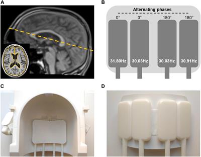 Real-Time Multifrequency MR Elastography of the Human Brain Reveals Rapid Changes in Viscoelasticity in Response to the Valsalva Maneuver